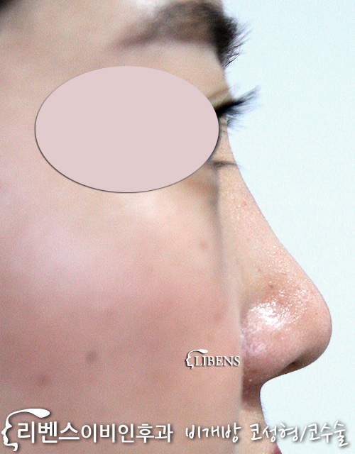 매부리코 코끝 비중격 연골 수술 성형 교정 묶기 무보형물 성형 s528